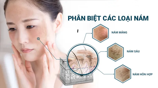 Nỗi ám ảnh mang tên tàn nhang, nám, mụn thịt trên làn da 4 Nám da là gì